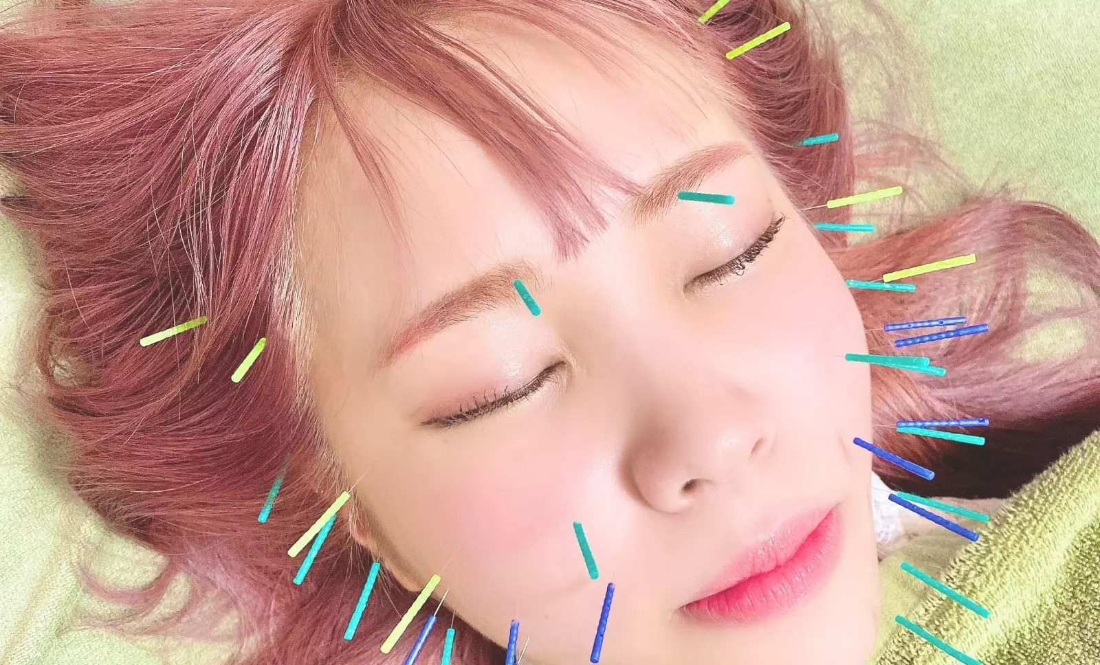 鍼をさしている画像